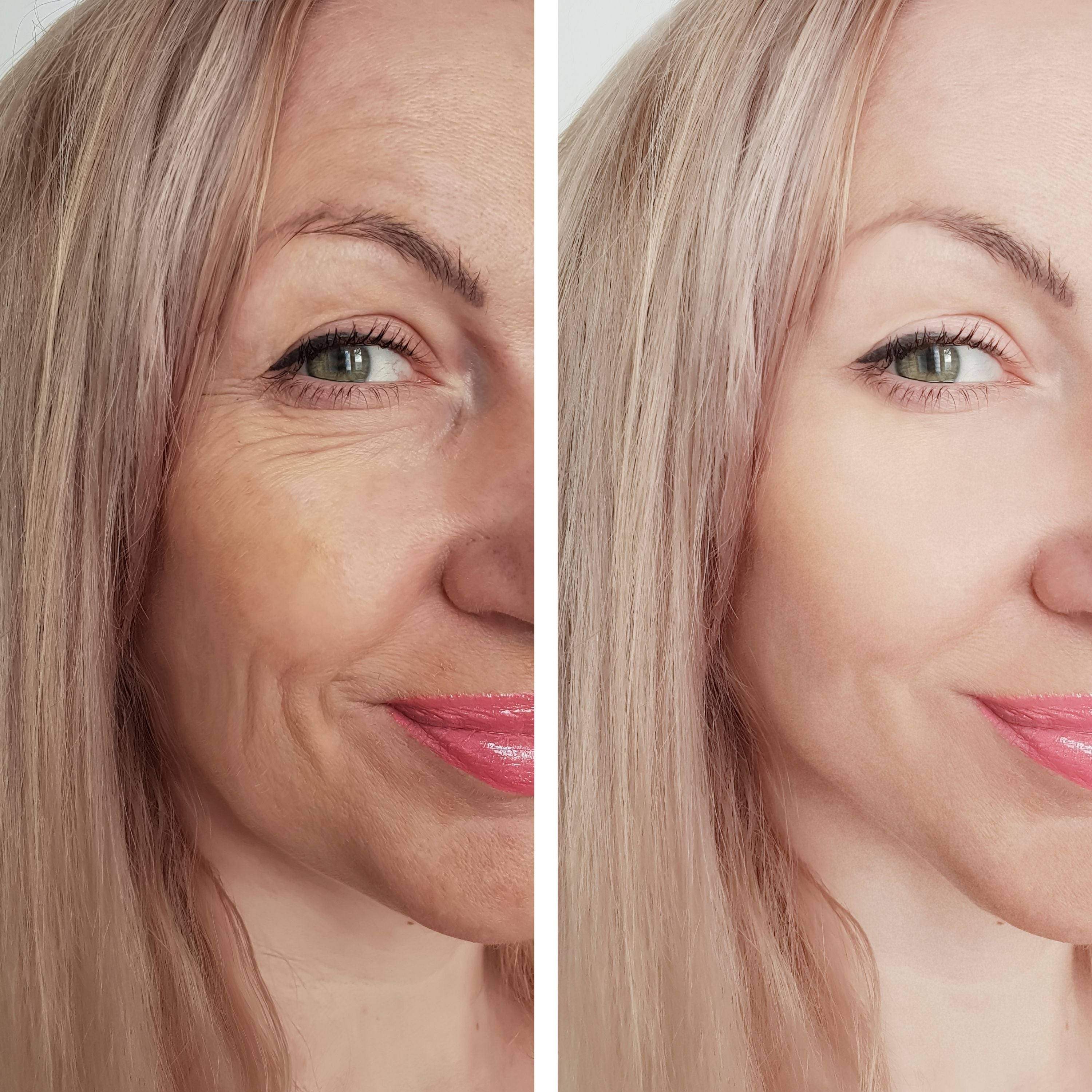 “Ozempic Face” Nedir ve Nasıl Önlenir?