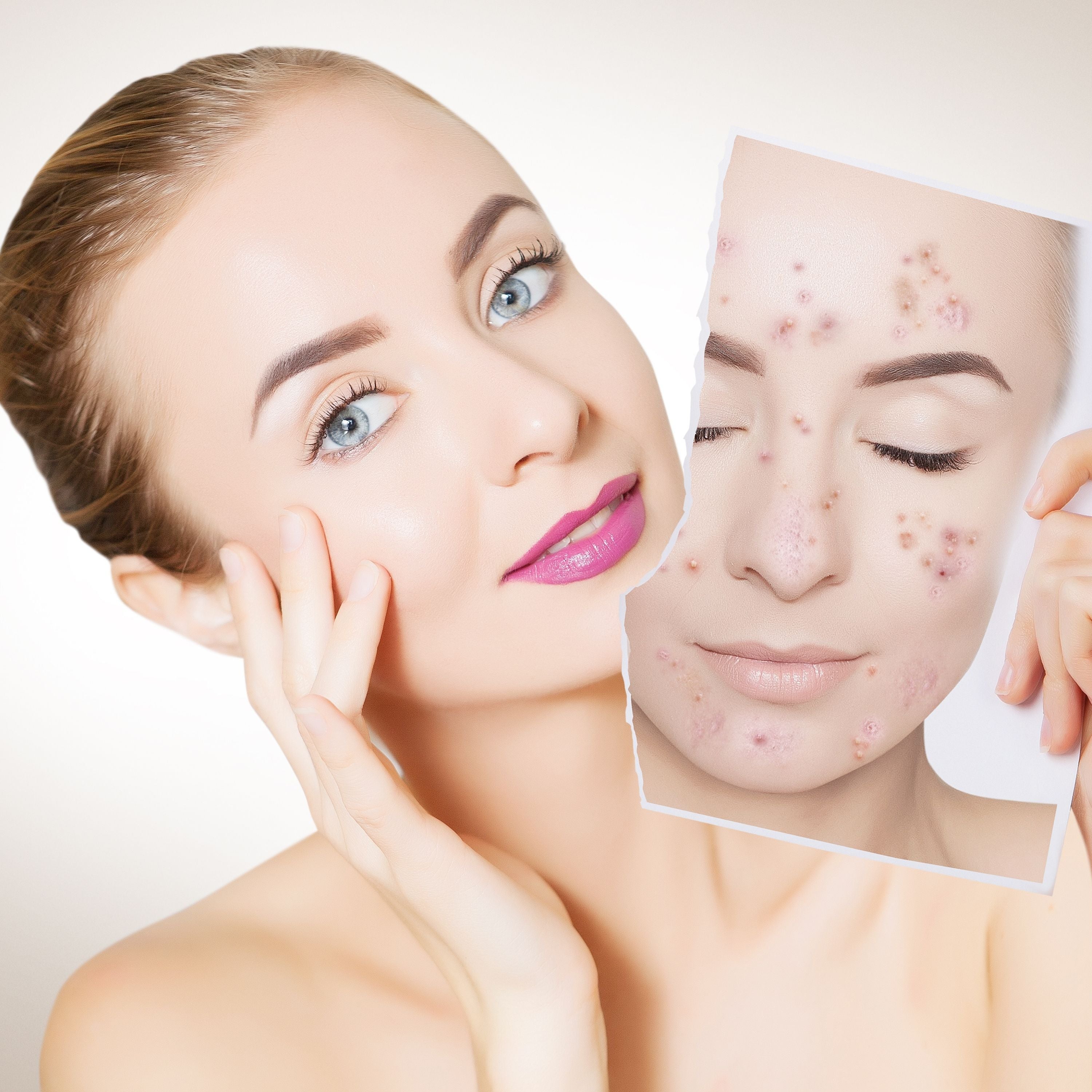 Hormonal Akne Her Yaşta Görülebilir. İşte Baş Etme Yolları